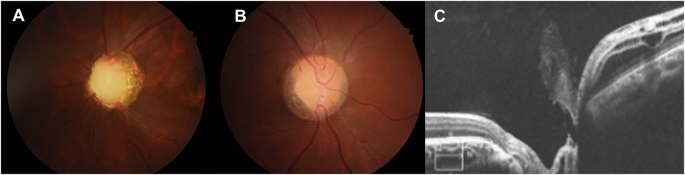 Two published retinal photographs and one OCT cross-section show different optic-disc and nearby retinal findings in PAX2-related disease.